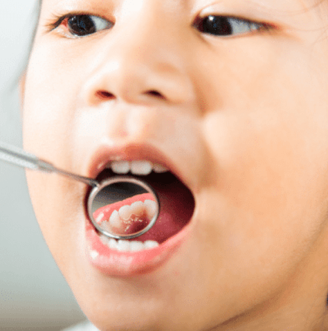 Phase 1 Orthodontics Explained: What It Can And Can’t Do